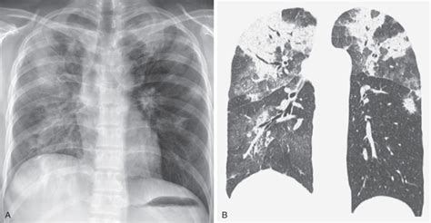 Cryptogenic Organizing Pneumonia/Secondary Organizing Pneumonia | Radiology Key