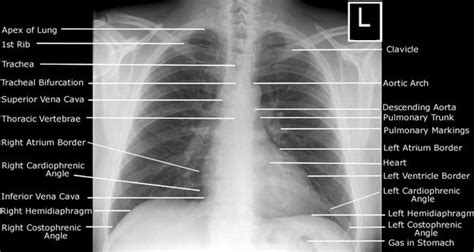 Systematic Approach to Frontal Chest X-ray | Epomedicine