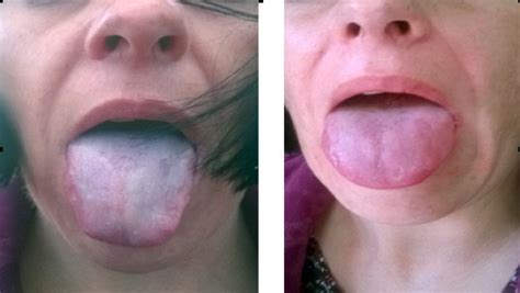 Painful whiteish-blue tongue discoloration caused by cold air followed... | Download Scientific ...