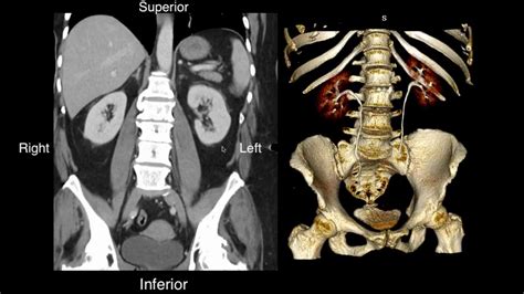 Normal CT Renal Anatomy