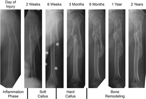 Fractures and Bone Healing