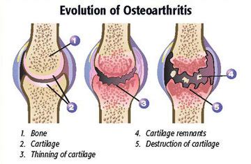 Osteoarthritis - The Skeletal System and its Diseases