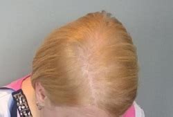 Telogen Effluvium Related Hair Loss | Hair Loss Cure 2020