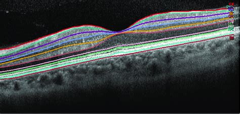 Segmentation of the retinal layers. Single horizontal foveal scans were... | Download Scientific ...