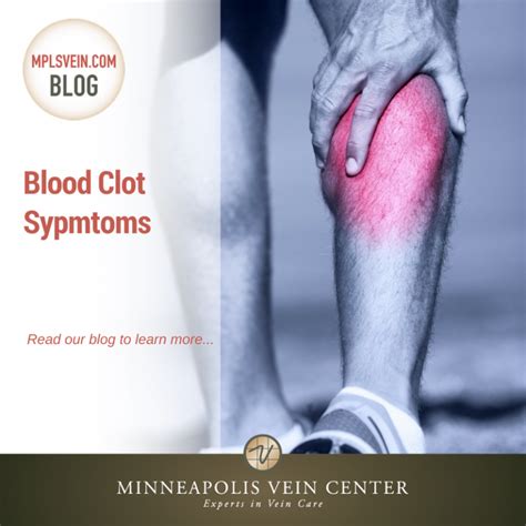 Blood Clot Symptoms: Minneapolis Vein Center: Interventional Radiologists