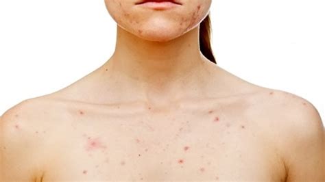 Chest Acne , The Causes And The Remedies | Health | Beautyonfleeck