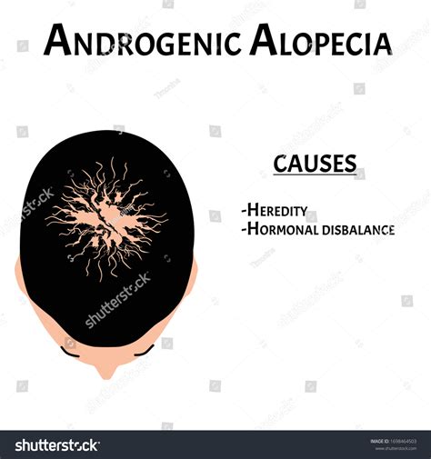 345 Male Androgenic Alopecia Images, Stock Photos & Vectors | Shutterstock