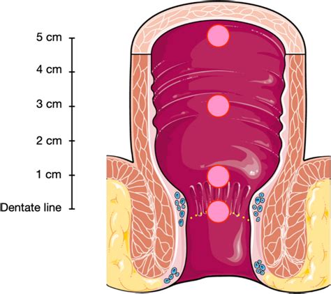 Enough is enough: how many rectal suction biopsies do you need to diagnose Hirschsprung’s ...