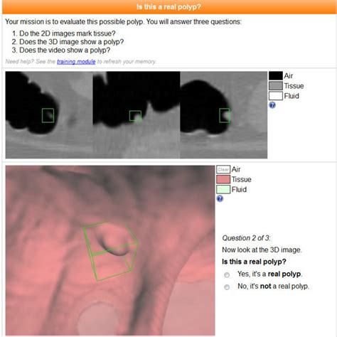 The VOI extraction for a 6 mm sessile polyp in a sigmoid colon. a) The... | Download Scientific ...