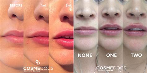 Lip Fillers Before and After Photos at CosmeDocs for Natural or Bold Lips