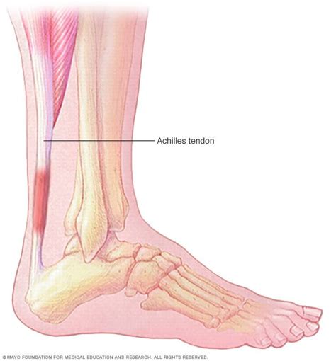 Achilles tendinitis Disease Reference Guide - Drugs.com