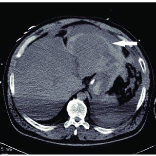 Non-contrast CT scan showing intraperitoneal hemoperitoneum extending... | Download Scientific ...