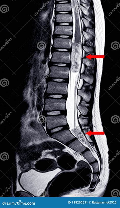 MRI Lumbar Spine IMPRESSION:Intra-dural Extramedullary Mass at Distal Cord and Conus Medullaris ...