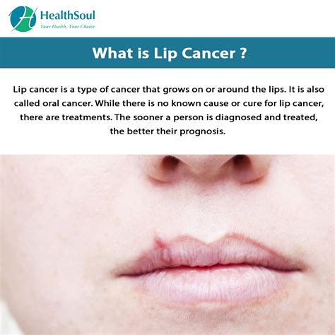 Lip Cancer: Causes, Symptoms and Treatment – Healthsoul