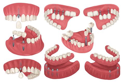 Dental Implants Restoration & its Types - New Columbia Dentistry