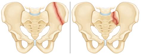 Pelvic Fracture Physiotherapy - Dear Adam Smith