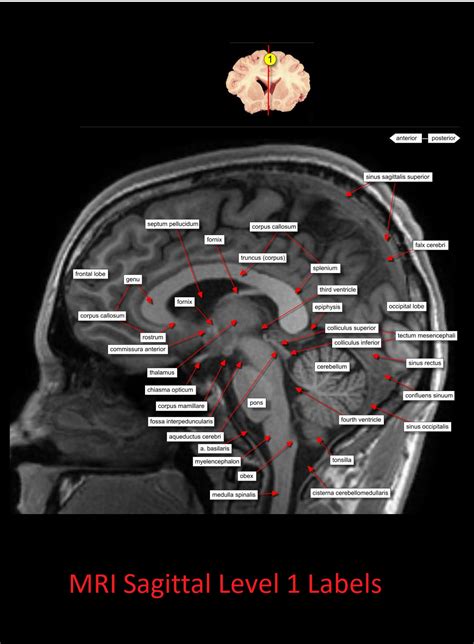 MRI Sagittal Anatomy of Brain Level 1 - NCLEX Quiz