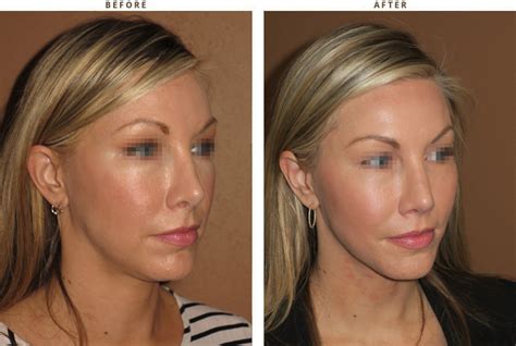 Mid Face Lift – Before and After Pictures * – Dr Turowski – Plastic Surgery Chicago