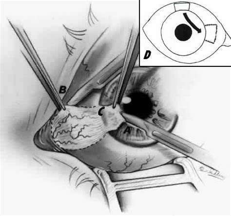 Pterygium Excision | Epomedicine