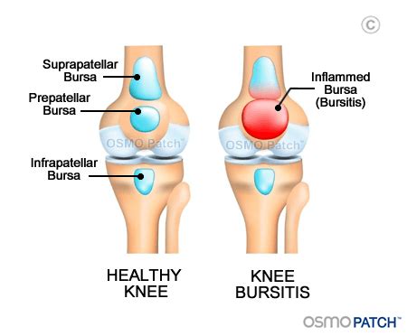 Knee Bursitis Information - What is Knee Bursitis? | OSMO Patch US