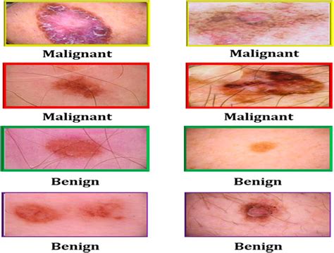 Melanoma Skin Moles