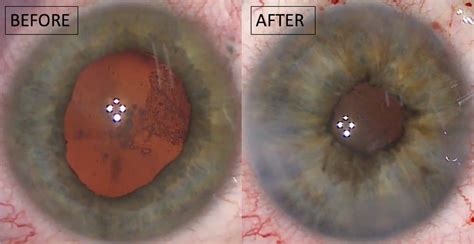 Iris Surgery, Iris Repair and Dislocated Lenses, Southport