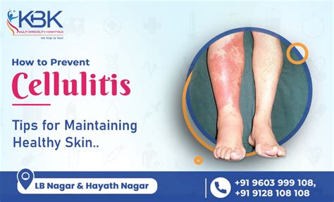 Cellulitis Treatment in Hyderabad Archives - kbkhopitals