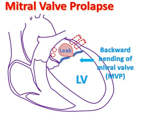 What is mitral valve prolapse (MVP)? – All About Heart And Blood Vessels