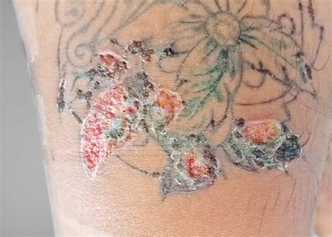 Share more than 74 rash on tattoo best - in.coedo.com.vn