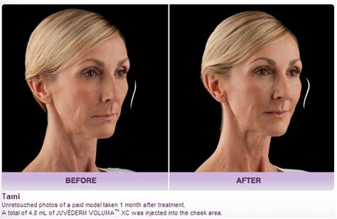 Juvederm Voluma Cheek Before After Photos Beverly Hills | Los Angeles