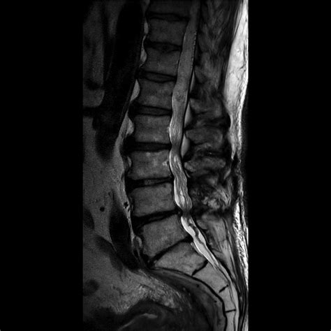 Lumbosacral Spine MRI | Radiology Key