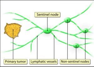 Sentinel Lymph Node - Pictures, Location, Biopsy, Dissection and Mapping