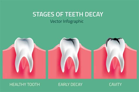 The Stages of Tooth Decay - Orthodontics Limited