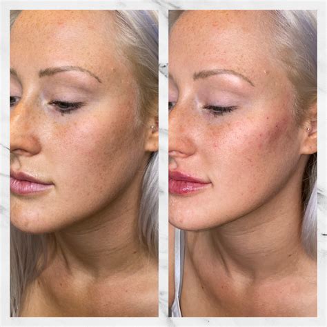 Face Fillers & Cheek Fillers in Gilbert | Colair Med Spa