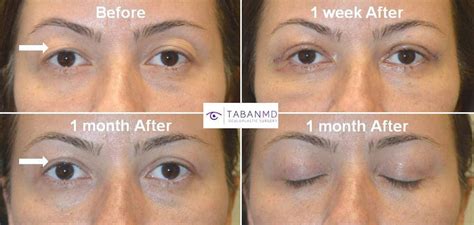 Upper Blepharoplasty Before After