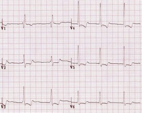 U Wave • LITFL Medical Blog • ECG Library Basics