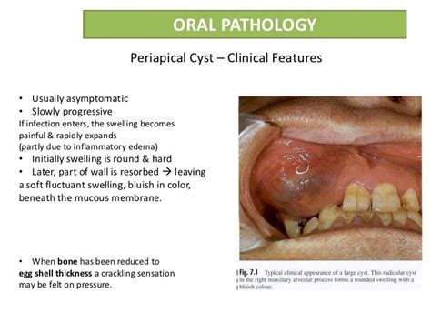 Radicular cyst or Periapical cyst