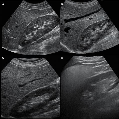 Understanding Fatty Liver Ultrasound Grading | Fatty Liver Guide