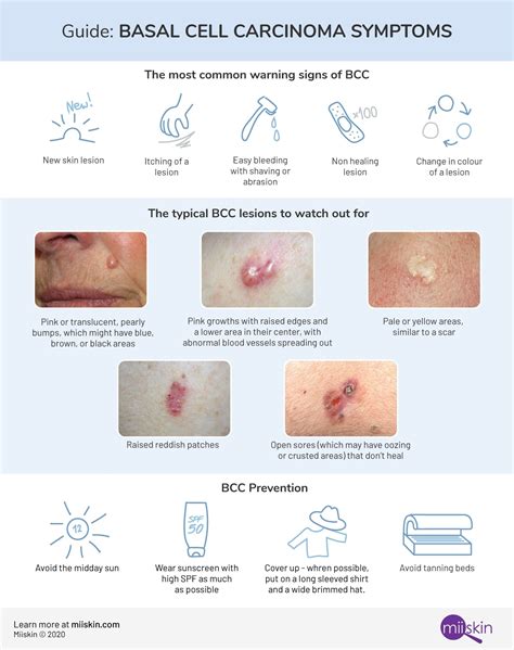 Skin Cancer Types Basal Cell Carcinoma Bcc Squamous Cell Images And ...