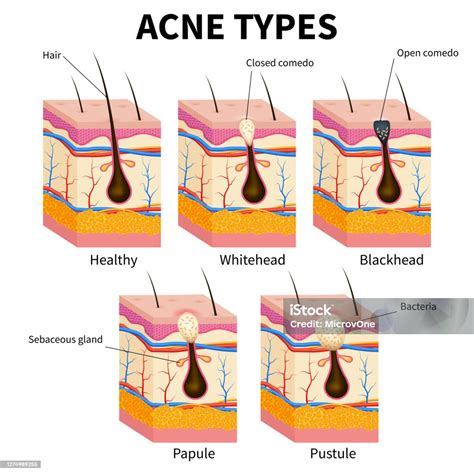 Acne Types Pimple Skin Diseases Anatomy Medical Vector Diagram Stock ...