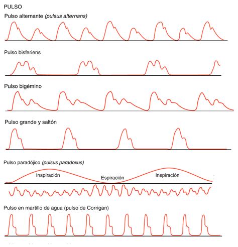 EMS SOLUTIONS INTERNATIONAL by @DrRamonReyesMD marca registrada: Pulso Dancing carotids Corrigan ...