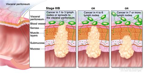 Colon Cancer Treatment - NCI