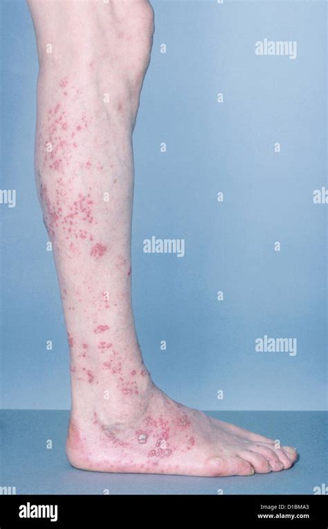 SHINGLES LESIONS ON LEG AND FOOT Stock Photo, Royalty Free Image: 52503195 - Alamy