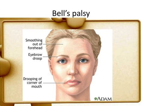 PPT - Bell’s Palsy PowerPoint Presentation, free download - ID:2184905