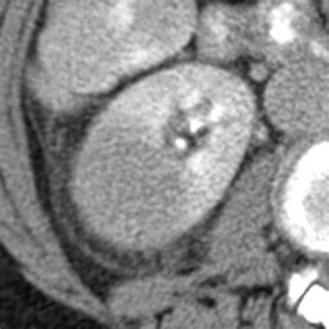 Ultimate Radiology : CASE OF BILATERAL PYELONEPHRITIS