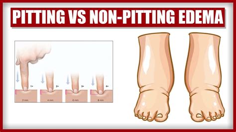 Pitting Edema Levels