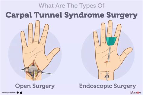 Carpal Tunnel Syndrome Surgery: Purpose, Procedure, Benefits and Side ...