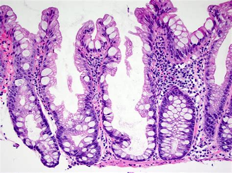 Sessile Polyp Histology