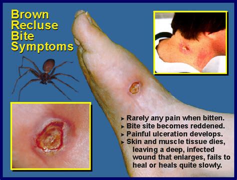 Brown Recluse Spider Bite Symptoms | Department of Entomology ...