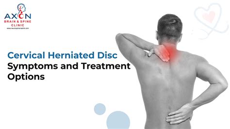 Cervical Herniated Disc Symptoms and Treatment Options